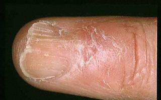 Матрикс ногтя: описание, строение и причины повреждения Повредила ногтевую пластину что делать