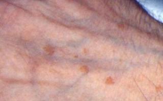 Дисхромия кожи: причины и лечение Дисхромия при гестации